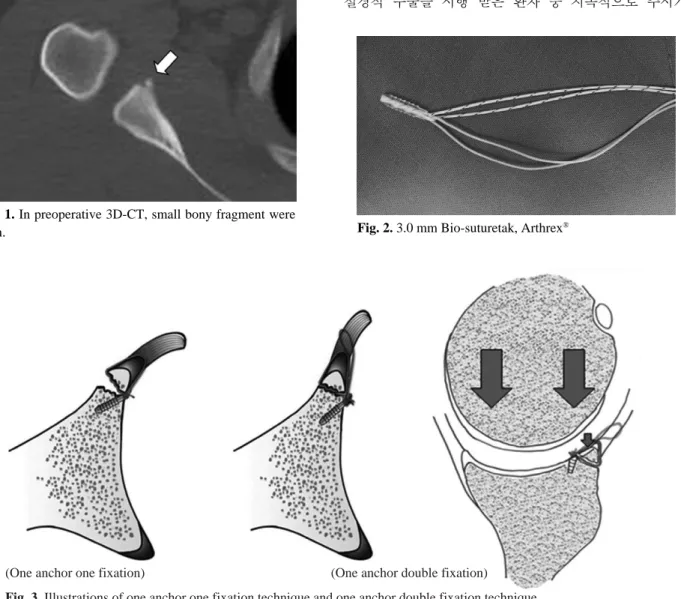 Fig. 3. Illustrations of one anchor one fixation technique and one anchor double fixation technique.