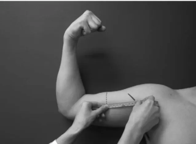 Fig. 1. BAD(biceps apex distance) is an index comparing the length of the medial border of pectoralis major and the apex of biceps bilaterally, and subsequently showing the difference of the lengths.