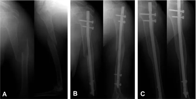 Fig. 2. 81-year-old female with left humerus shaft fracture underwent the operation of closed reduction and antegrade interlocking intramedullary nailing