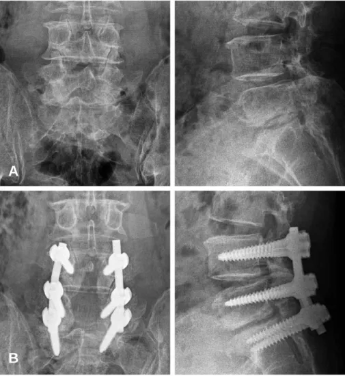 Fig. 2. (A) A 62-year-old male’s preoperative simple radiograph shows spinal stenosis L4-S1