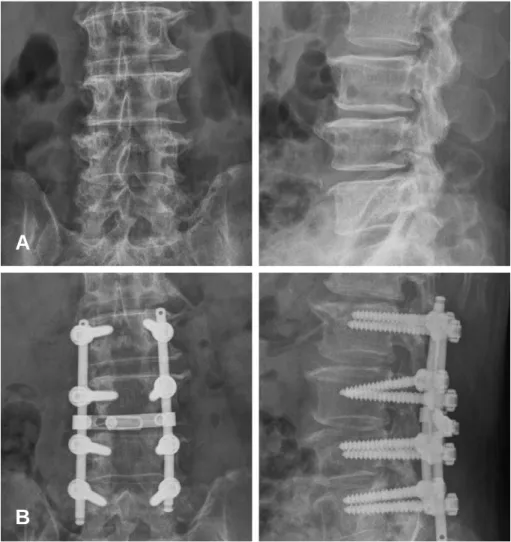 Fig. 4. (A) A 52-year-old male’s preoperative simple radiograph shows spinal stenosis L2-5