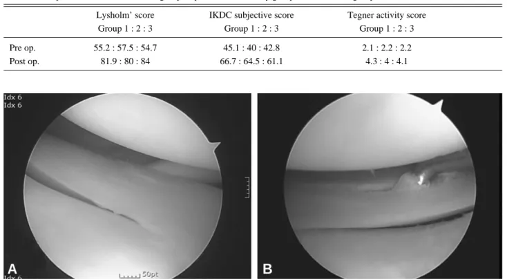 Table 4. Comparision of score in sutured group vs partial menisectomy group vs observation group 