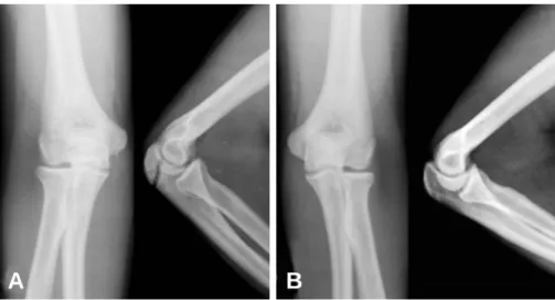 Fig. 1. Radiographs demonstrate transverse stress fracture with sclerotic margin in right elbow (A) compared with no specific change in left elbow (B).