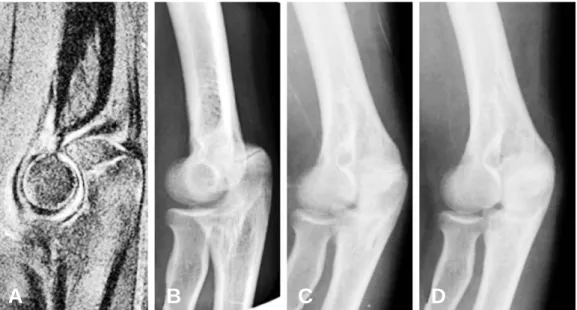 Fig. 5. (A) MRI image shows fracture line in olecranon. (B,  C and  D, respectively) The fracture progresses to union in the radi- radi-ographs taken at 1, 2 and 3 months.