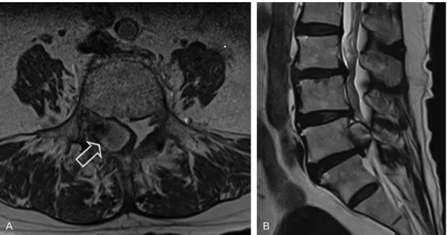 Fig. 1. (A) Initial T2-weighted axial image showing a severely compressed and left-side deviated thecal sac (open white arrow)