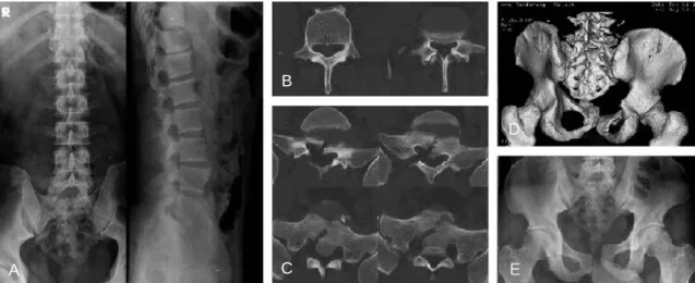 Fig. 1. Initial radiographic findings show (A) simple lumbar anterior-posterior and lateral X-ray views, (B) L4, 5 uni- uni-lateral transverse process fracture on computed tomography (CT) imaging, (C)  comminuted and displaced sacral fracture lines on CT i