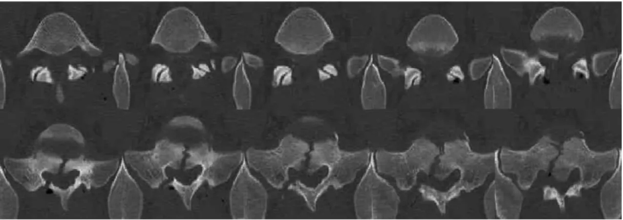 Fig. 3. This computed tomography (CT) image shows reduced L5-S1 facet joint without fusion (upper row)