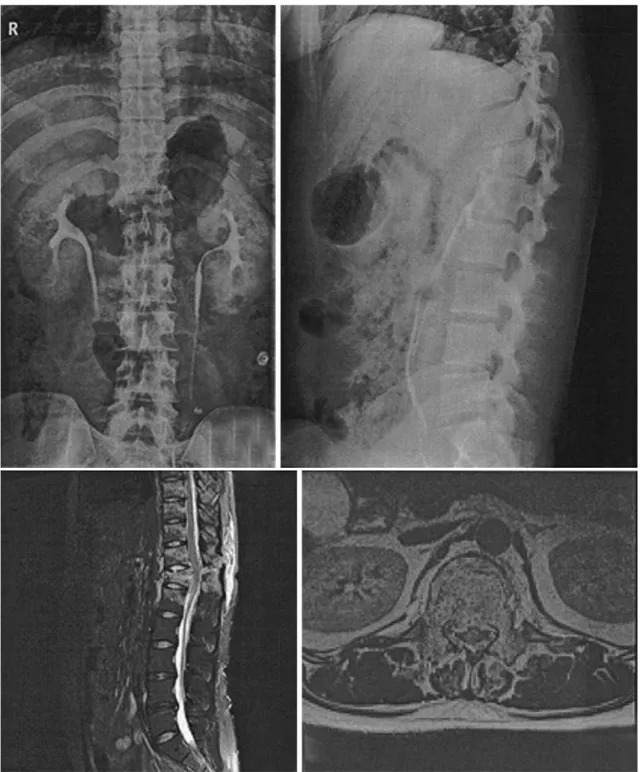 Fig. 2. T12 flexion burst fracture in patient with incomplete spinal cord injury. Compression injury (1 point) with burst component (1 point), injury to posterior ligament complex (3 point) and incomplete spinal cord injury (3 point).