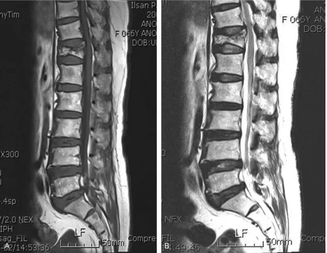Fig. 2. Sagittal T1 weighted (A) and T2 weight (B) images show linear areas of low intensity with bone marrow replacement in T12 vertebral body.