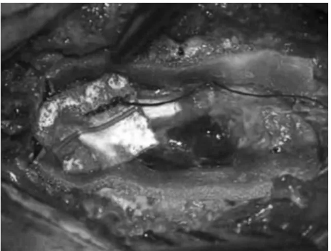 Fig. 2. As soon as laminectomy had been performed, an epidural, firm, a black neoplasm was encountered, which invaded the pedicle and distorted the spinal cord due to ventral involvement.