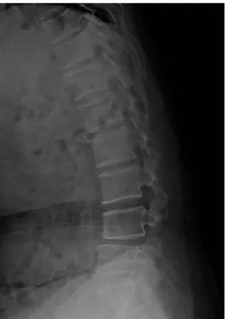 Fig. 2. Posterior decompression and lumbar interbody fusion with cages were performed using the posterior approach.