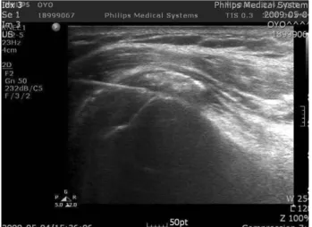 Fig. 7. Sonographic appearance of calcification after ESWT. The hyperechoic shadow became a  lit-tle bit hypoechoic, representing breaking down of the calcific mass into more fine granules.