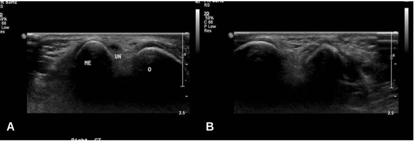 Fig. 6. Compared to the right ulnar nerve, the left ulnar nerve was not present in the cubital tunnel because anteri- anteri-or transposition was done of anterianteri-or to the medial epicondyle.(ME: medial epicondyle, UN: ulnar nerve, O:
