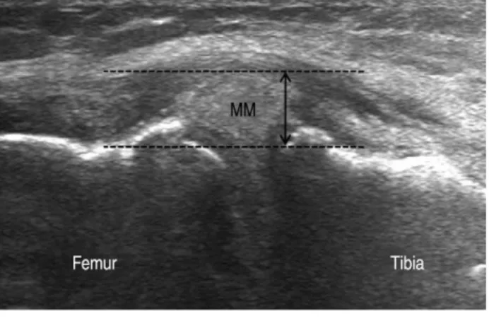 Table 1. The Degree of Medial meniscus Extrusion According to the Medial Joint Space Grades in each Group.