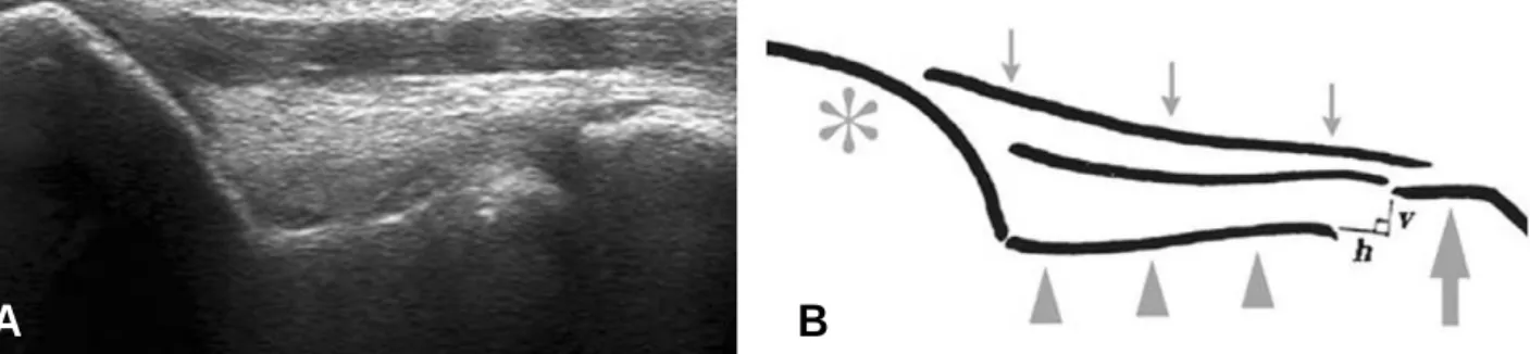Table 1. Comparison of medial elbow laxity between weight-lifter and control group