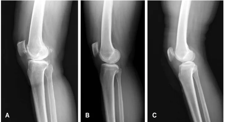 Fig. 1. Simple lateral radiographs showing the knee effusion. Grade I is fully visible suprapatellar and prefemoral fat pad (A)