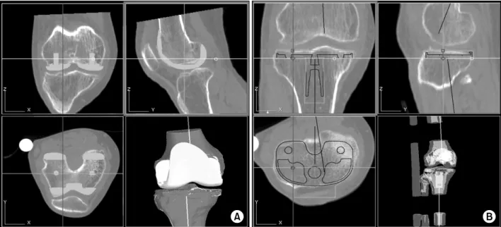 Fig. 1. Virtual surgery is conducted to verify femoral (A) and tibial (B) component alignment and size with respect to the  established femoral and tibial mechanical axes