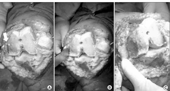 Fig. 1. After the osteotomy site (arrow) was marked (A), the medial epicondylar osteotomy was performed by the osteotome in 90 o  flexion (B)