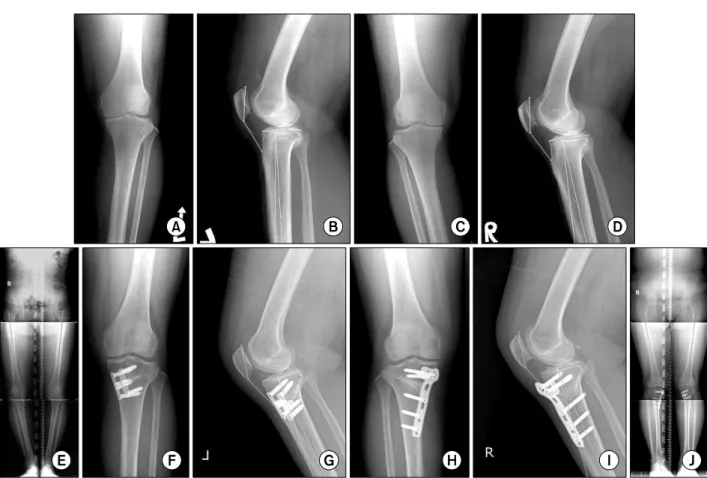 Fig. 1. (A-E) These photos are of a 48 year-old patient with osteoarthritis on both knee