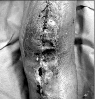 Fig. 1. On the twenty-fourth postoperative day, skin wound  after debridement couldn’t be approximated