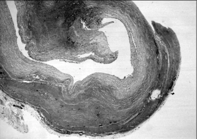Fig. 4. Light micrograph demonstrates thick walled cystic  space and characteristic focal myxoid change in the matrix  (H&amp;E stain, ×40)  소 소견을 보였다