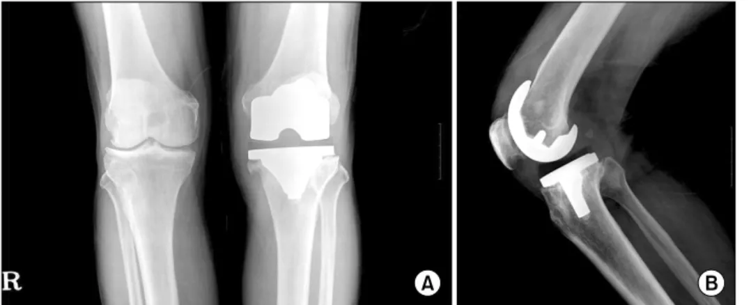 Fig. 1. A-P (A) and lateral (B) plain  radiographs of 71 years  old male patient reveal  peripro-sthetic bony resorption and  destruction about components.