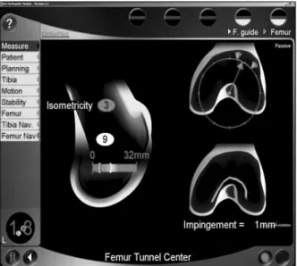Fig. 12. Femoral tunnel was created at the most isometric  point (as 3 mm of isometricity) displayed by navigation