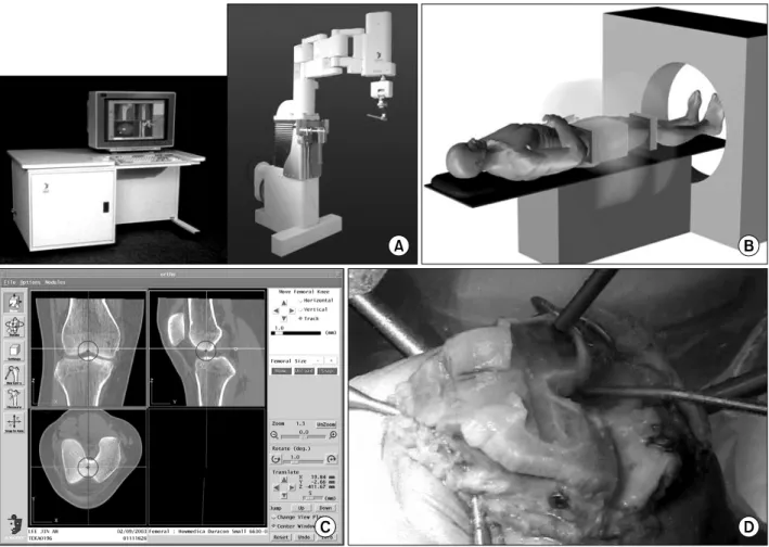 Fig. 1. Photographs of Robodoc Ⓡ  system. Processing is B→D. (A) appearance, (B) CT scanning, (C) planning, (D) milling; 