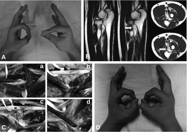 Fig. 1. (A) The inability to form an ‘O’ with the thumb and the index finger in the right hand