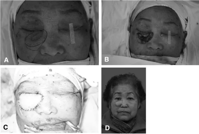 Fig. 1. Case 1. (A) Preopertive finding. (B) Intraoperative finding. (C) Reconstruction with anterolateral thigh per- per-forator free flap