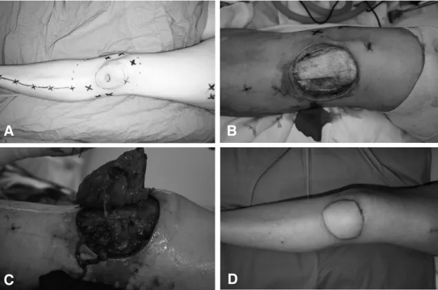 Fig. 2. Case 2. (A) Preoperative finding. (B) Intraoperative finding. (C) Reconstruction with bilobed chimeric antero- antero-lateral thigh perforator free flap using supermicrosurgical technique