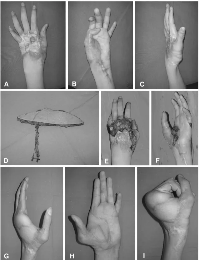 Fig 1. (A, B, C) Preoperative view shows unstable scar on the dorsum and severe scar contracture of the palm as well as the first web space of the left hand