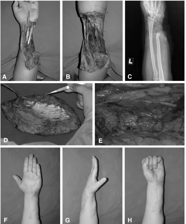 Fig 2. (A, B, C) Preoperative view shows composite tissue defect including distal ulna bone, ulna nerve, ulnar artery and flexor carpi ulnaris as well as huge soft tissue defect
