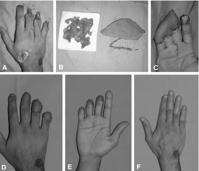 Fig 3. (A) Preoperative view shows multiple finger tip injureis with soft tissue defects on the right index, long, ring, small finger