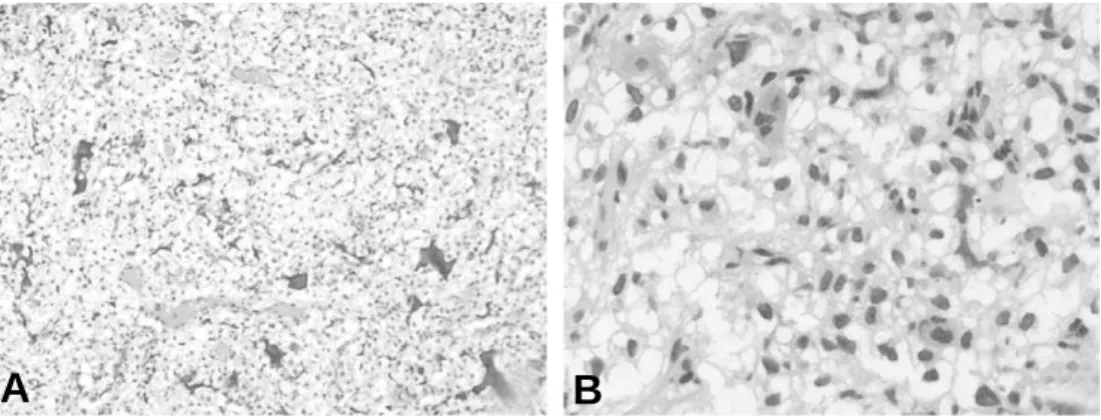 Fig. 2. Histologic appearance of clear cell chondrosarcoma. Compact sheets of tumor cells with round or ovoid shaped, clear cytoplasm and central small nuclei