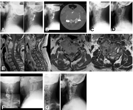 Fig. 1. (A) Preoperative films shows osteolysis of C3 vertebra, and post operative film shows