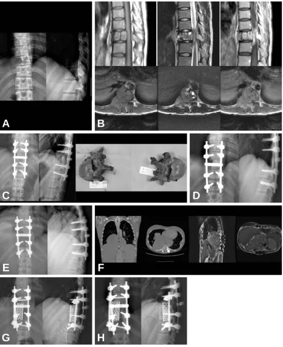 Fig. 2. (A) Plain films show osteolysis and collapse of T10 vertebral body. (B) MRIs show mass inva- inva-sion T10 vertebral body &amp; rt
