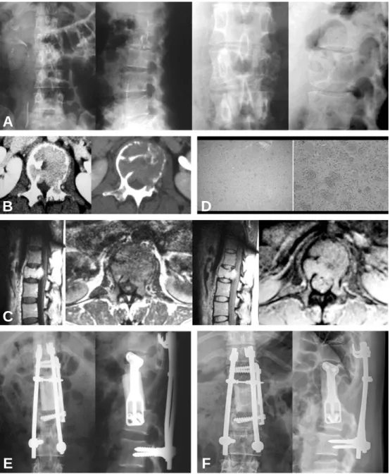 Fig. 3. (A) Plain films show osteolysis and collapse of L1 vertebral body. (B) CTs show invasion of spinal canal by the tumor and destruction of vertebral body, left pedicle