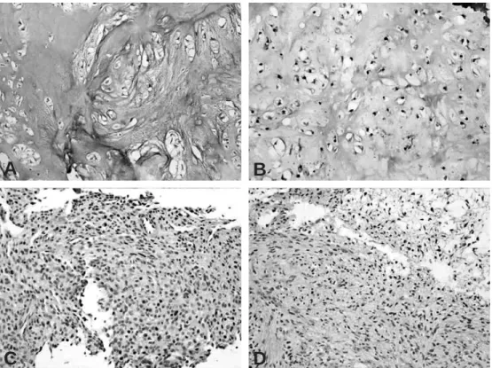 Fig. 1. pSTAT3 expression in benign chondroid tumors. (A) Two cases (33.3%) of enchondroma were negative