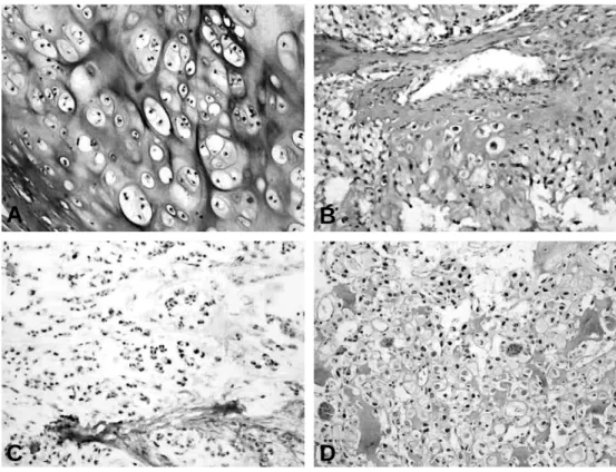 Fig. 2. pSTAT3 expression in malignant chondroid tumors. (A) All grade I conventional chondrosar- chondrosar-comas were negative
