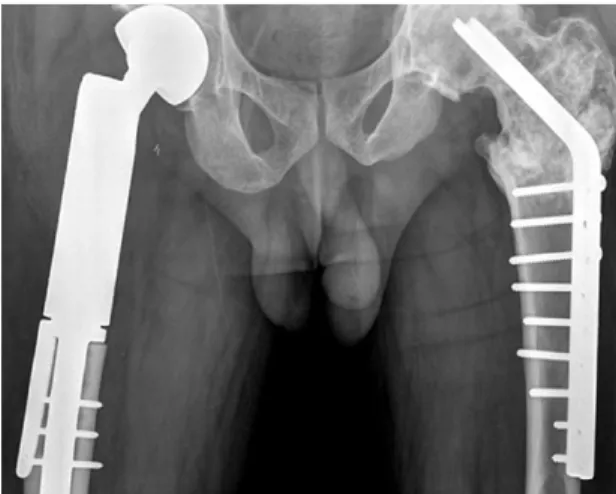 Fig. 5. Malignant fibrous stroma with sheets of pleomor- pleomor-phic cells intermixed with giant cells