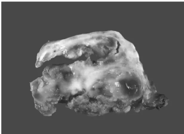 Fig. 4. Microscopically, the tumor consists of diffusely interspersed multi-nucleated, osteoclast-like giant cells on a background of oval to spindle-shaped mononuclear stromal cells (Hematoxylin &amp; eosin stain