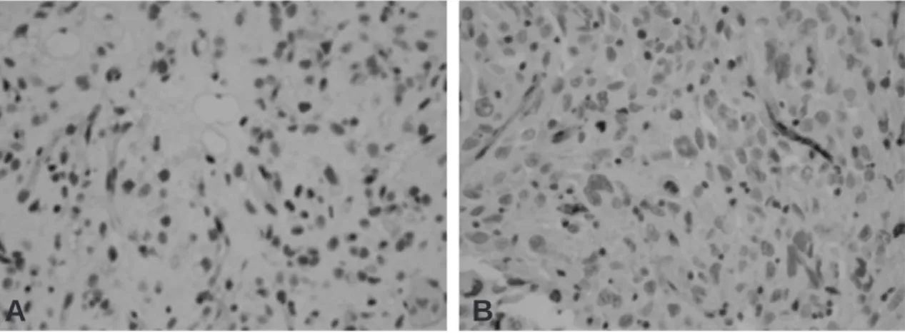 Fig. 1. Immunohistochemical staining for MGMT. Brown-colored nuclear staining was regarded as positive staining.