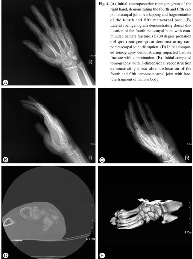Fig. 4. (A) Initial anteroposterior roentgenogram of the right hand, demonstrating the fourth and fifth  car-pometacarpal joint overlapping and fragmentation of the fourth and fifth metacarpal base