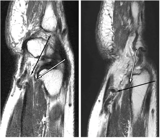 Fig. 1.Torsion of ulnar artery is noted (Black arrow) The ulnar nerve is compressed (White arrow) by the ulnar around the ulnar nerve in abnormal course.