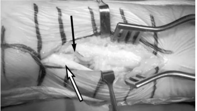 Fig. 4. Dissection of sheath between artery (Black arrow)and nerve (White arrow).