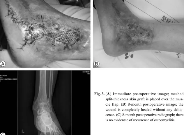 Fig. 3. (A) Immediate postoperative image; meshed split-thickness skin graft is placed over the  mus-cle flap
