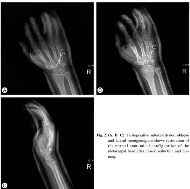 Table 1. Summary data of the fourth and fifth carpomatacapal fracture