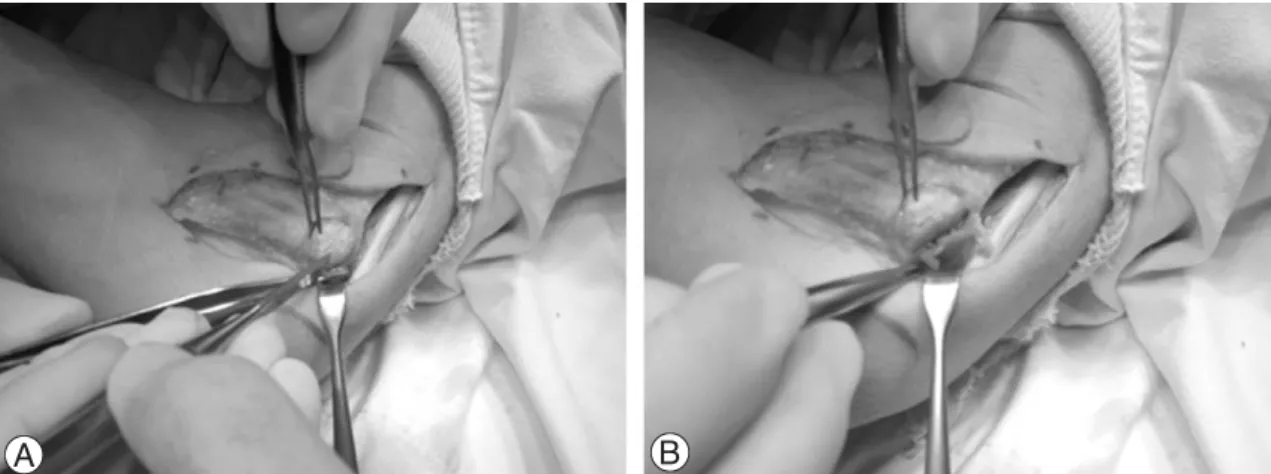 Fig. 1. (A, B) The guide for the proper plane of osteotome for the medial epicondyle was done and the ulnar nerve was protected by vein retractor
