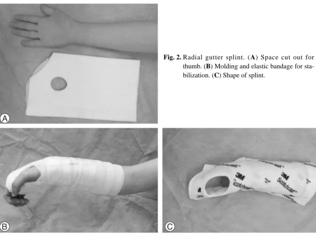 A Comparison Of Sugar Tong Splint And Radial Gutter Short Arm Splint After Closed Reduction Of 7594